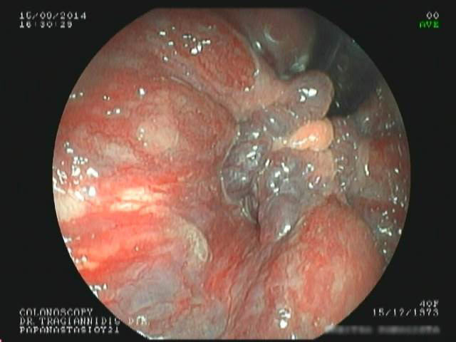Αιμορροϊδοπάθεια-1