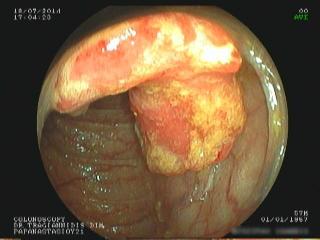 Καρκίνος παχέος εντέρου - 2