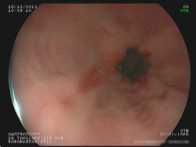 Οισοφαγίτιδα-2