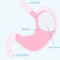 Ενδογαστρικό μπαλόνι